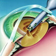 Размягчение хрусталика ультразвуком