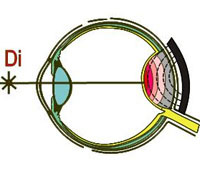 Транспупиллярная термотерапия