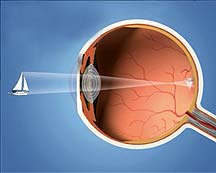 Близорукость, миопия