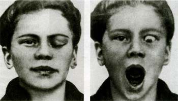 Синдром Маркуса-Гунна