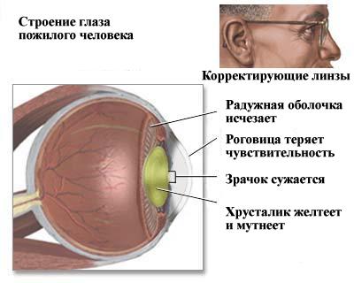 виды катаракты