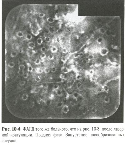 Запустение новообразованных сосудов