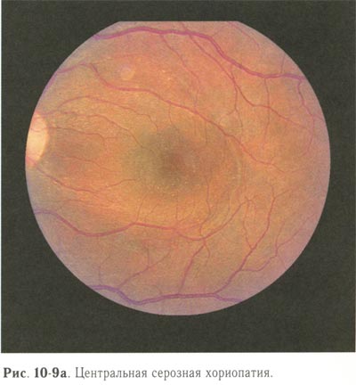 Центральная серозная хориопатия