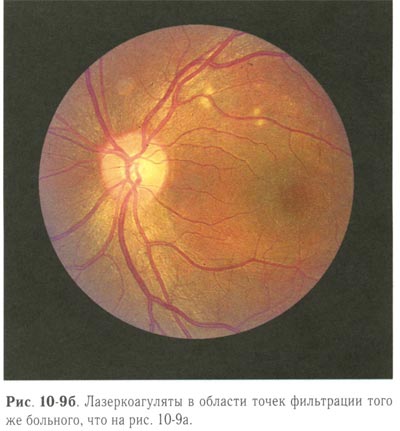 Центральная серозная хориопатия